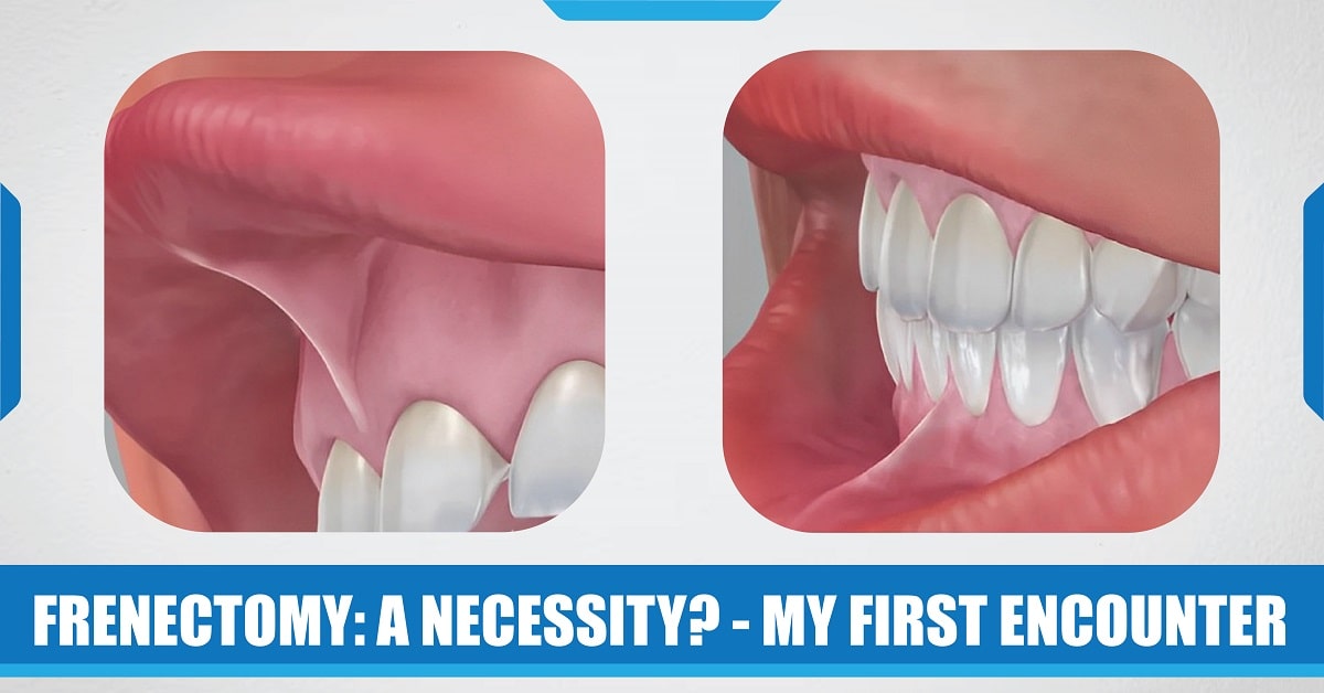 Frenectomy: a Necessity? - My First Encounter