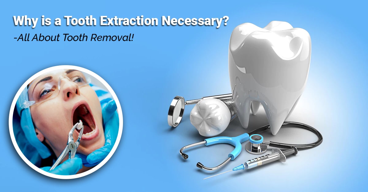 Why is a Tooth Extraction Necessary? - All About Tooth Removal!