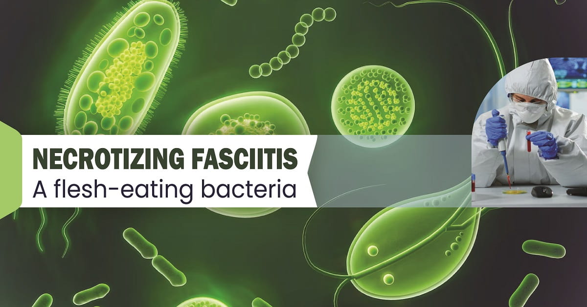 Necrotizing Fasciitis: a Flesh-Eating Bacteria