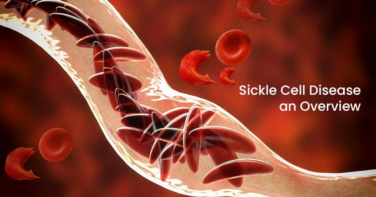 Sickle Cell Disease: an Overview
