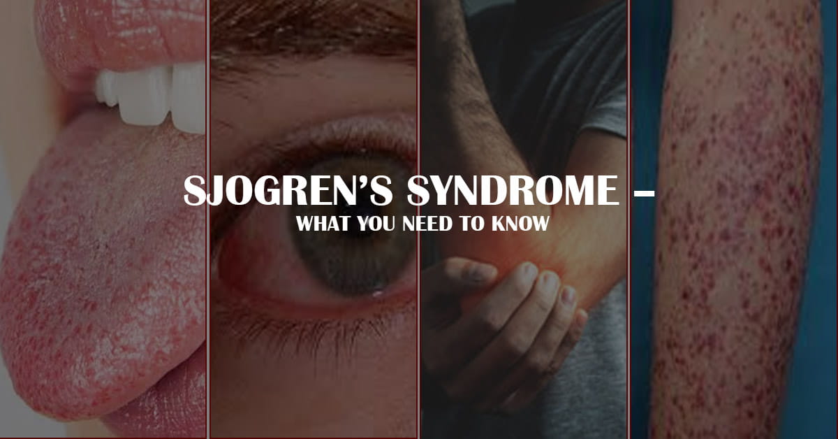 Sjogren's Syndrome – What You Need to Know