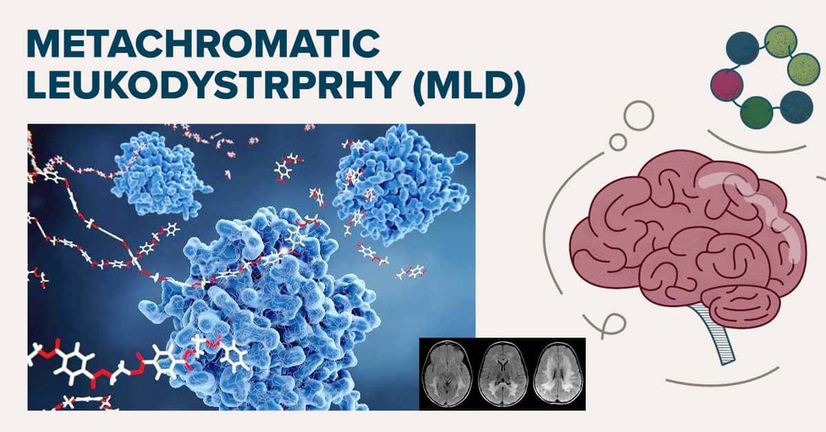 Metachromatic Leukodystrophy: a Rare Lipid Accumulation Neural Disorder