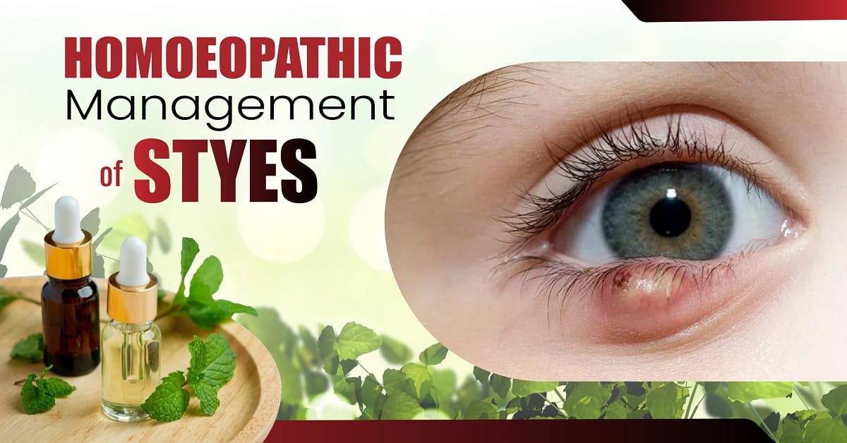 Homoeopathic Management of Styes