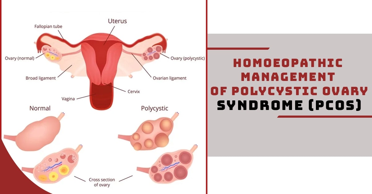 Homoeopathic Management of Polycystic Ovary Syndrome (PCOS)