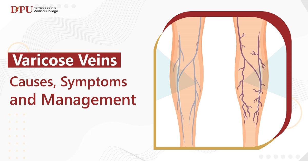 Varicose Veins: Causes, Symptoms, and Management