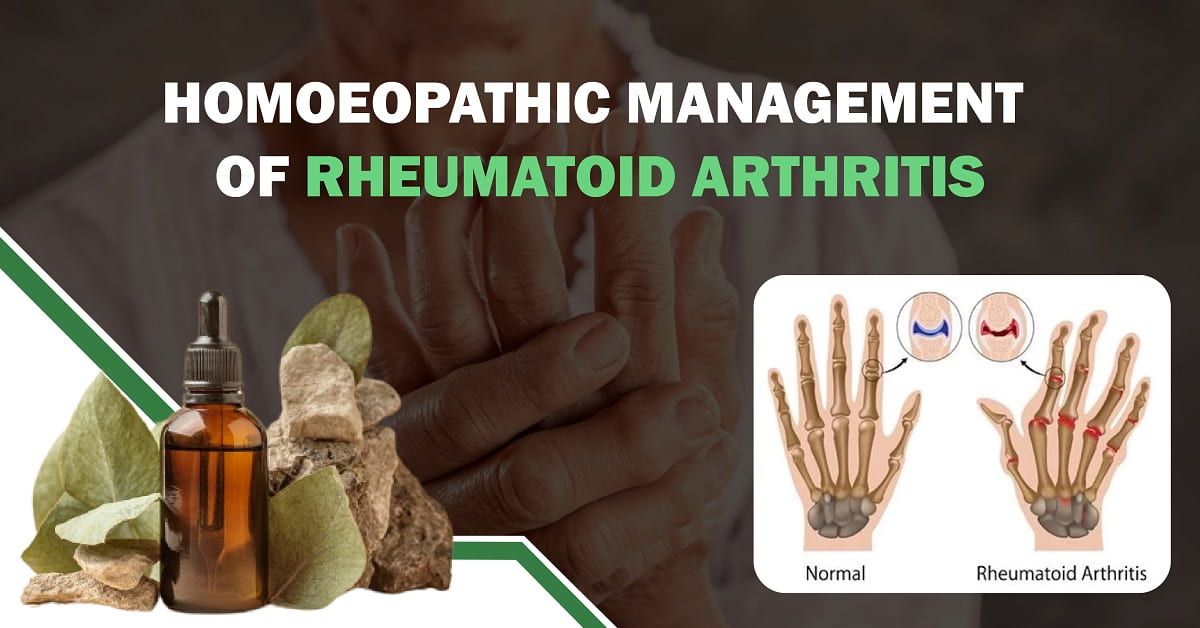 Homoeopathic Management of Rheumatoid Arthritis